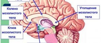 Агенезия мозолистого тела (АМТ) у новорожденного, плода, детей. Что это такое, симптомы, последствия