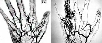 Angiography of the hands photo images