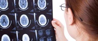 Brain atrophy: causes, classification and stages