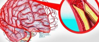 Cholesterol plaques in the blood vessels of the brain