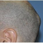 Painful bumps on the head. Bumps appeared under the skin on the head: what to do and how to treat 