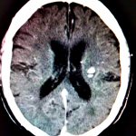 what are gliosis lesions