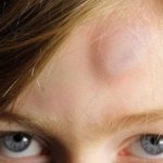 What to do in this case? How to relieve pain and remove an unsightly bruise from your forehead? 