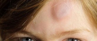 What to do in this case? How to relieve pain and remove an unsightly bruise from your forehead? 
