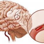 cerebral vascular dystonia