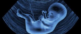 Fetal hydrocephalus on ultrasound