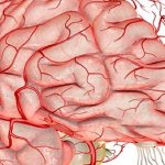 Hypoplasia of cerebral vessels