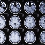 Brain tumor headache: symptoms and signs