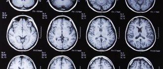 Brain tumor headache: symptoms and signs