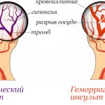 Illustration showing two types of stroke