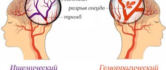 Иллюстрация показывающая два вида инсульта