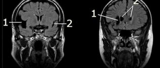 Cysts in the brain in newborns, what to do.