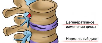 Radicular syndrome