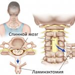 Laminectomy is performed to relieve spinal cord compression