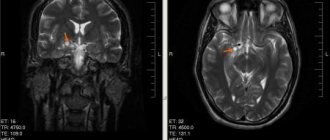 Treatment of brain glioma abroad