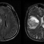MRI for concussion