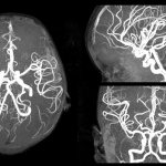 MRI image of a child&#39;s brain vessels