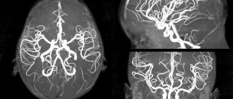MRI image of a child&#39;s brain vessels