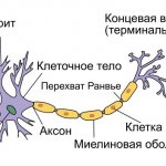 Neuroma develops from Schwann cells