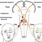 Неврит лицевого нерва (паралич Белла)
