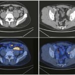 tumor on PET-CT image