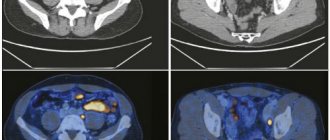 tumor on PET-CT image