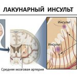 Особенности поражения мозга при лакунарном инсульте