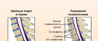 Osteocondritis of the spine