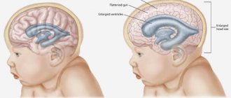 Cerebral edema in newborns - features of the development of the disease and possible complications