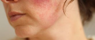 Facial redness and headache in children, men, women. Causes, treatment 