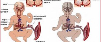 Consequences of hypoxia in a newborn during childbirth, mental development disorders. Treatment 