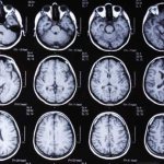 Signs of encephalopathy on CT