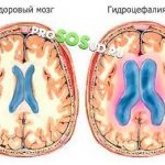 Expansion of the cerebrospinal fluid spaces of the brain in adults