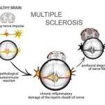 Схема: функционирование мозга при рассеянном склерозе