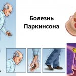 Symptoms of Parkinson&#39;s disease