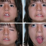 Mobius syndrome in children photo