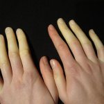 Raynaud&#39;s syndrome