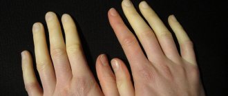 Raynaud&#39;s syndrome