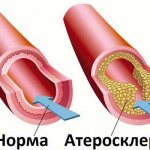 Vessel for atherosclerosis