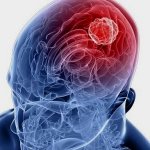 У ослабленных людей и при неправильном лечении герпеса может пострадать головной мозг