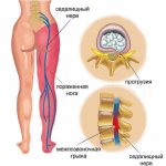 Pinched sciatic nerve: Therapeutic exercises