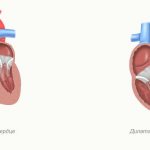 Healthy heart and heart with dilatation of all chambers