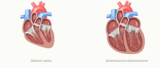 Healthy heart and heart with dilatation of all chambers